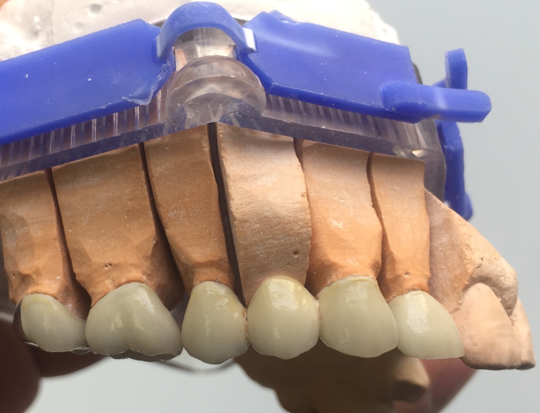 Before: Ceramic Crowns & Bridgework