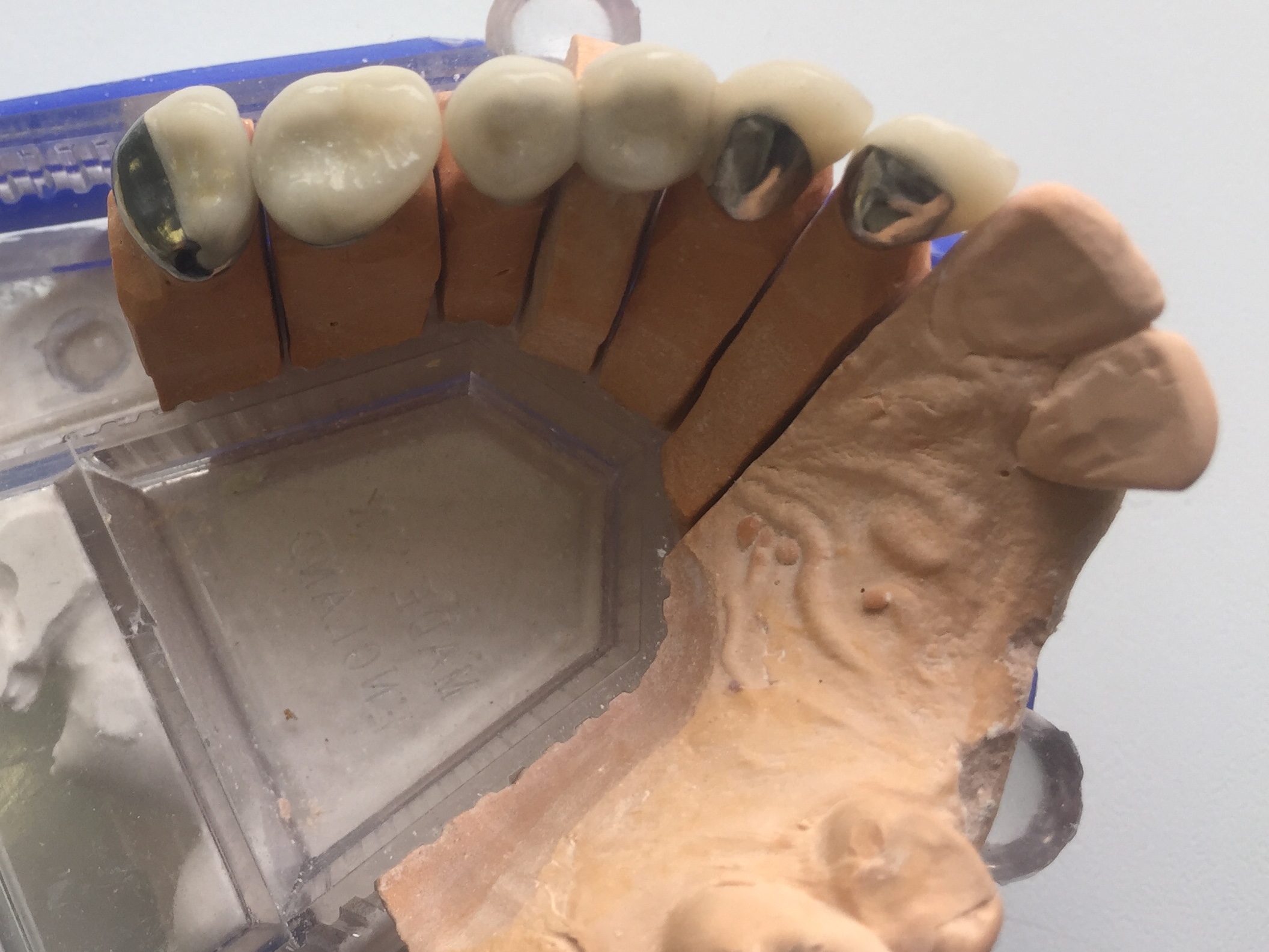 After: Ceramic Crowns & Bridgework