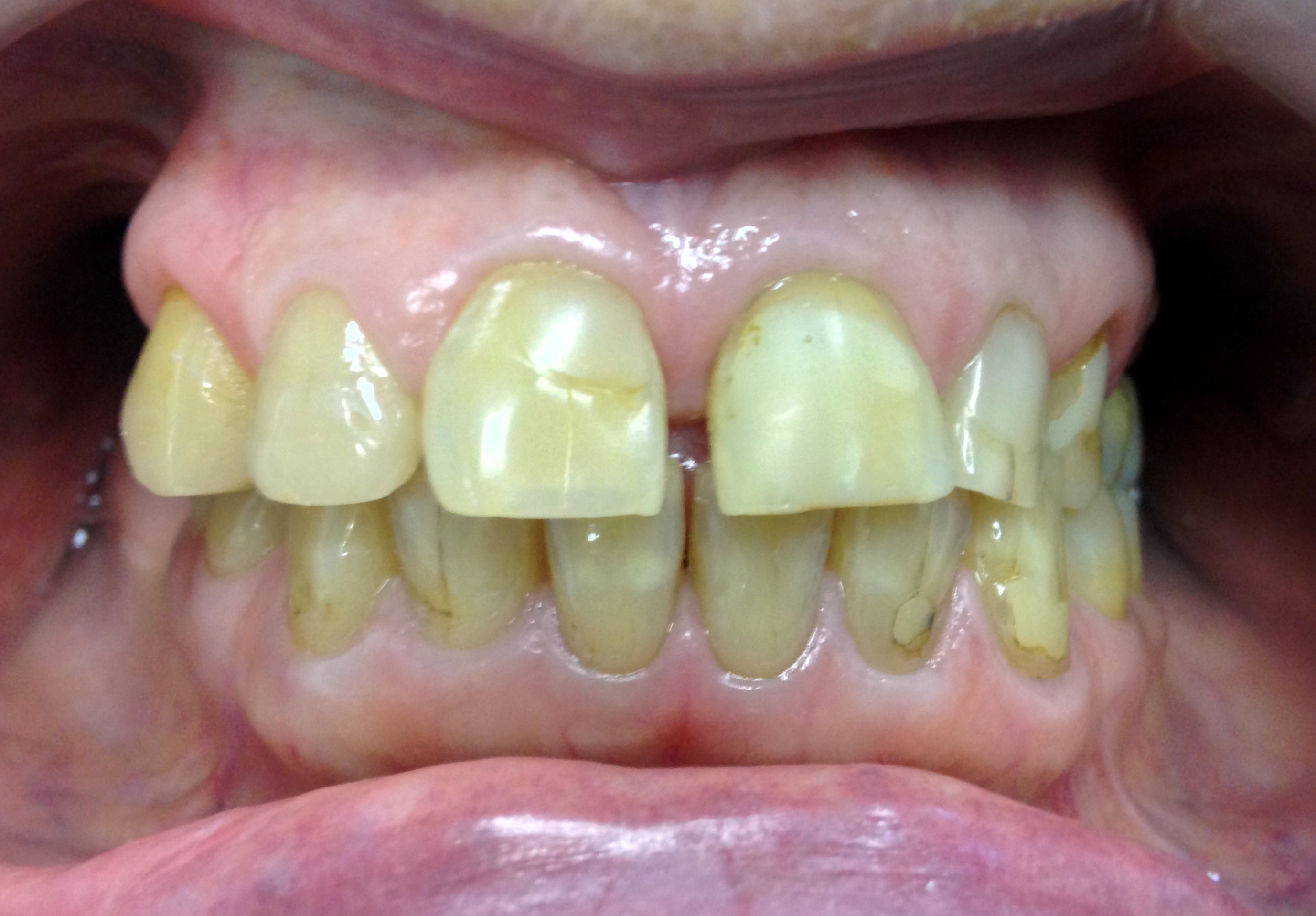 Before: Full Smile Restoration