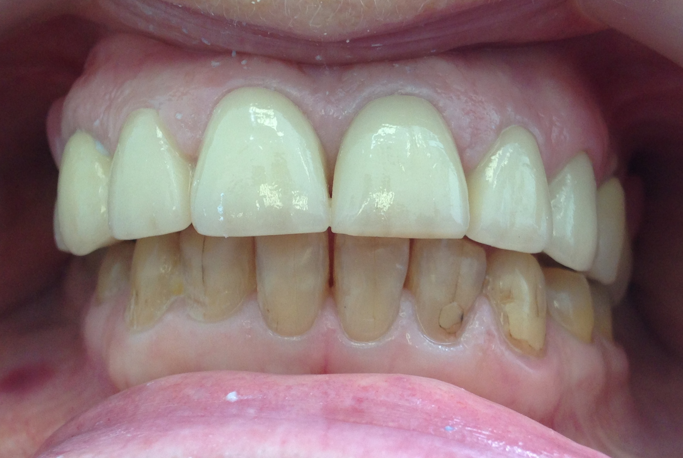 After: Full Smile Restoration
