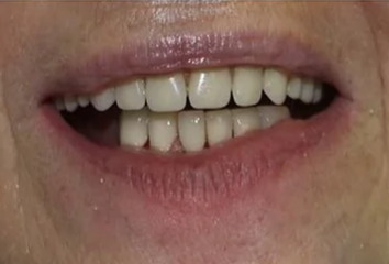 After: Anterior Alignment & Bonding