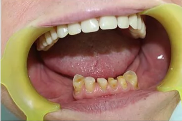 Before: Anterior Alignment & Bonding