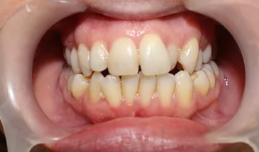 Before: Aesthetic Tooth Rejuvenation
