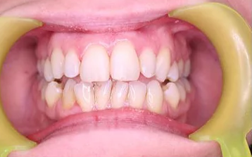 After: Aesthetic Tooth Rejuvenation